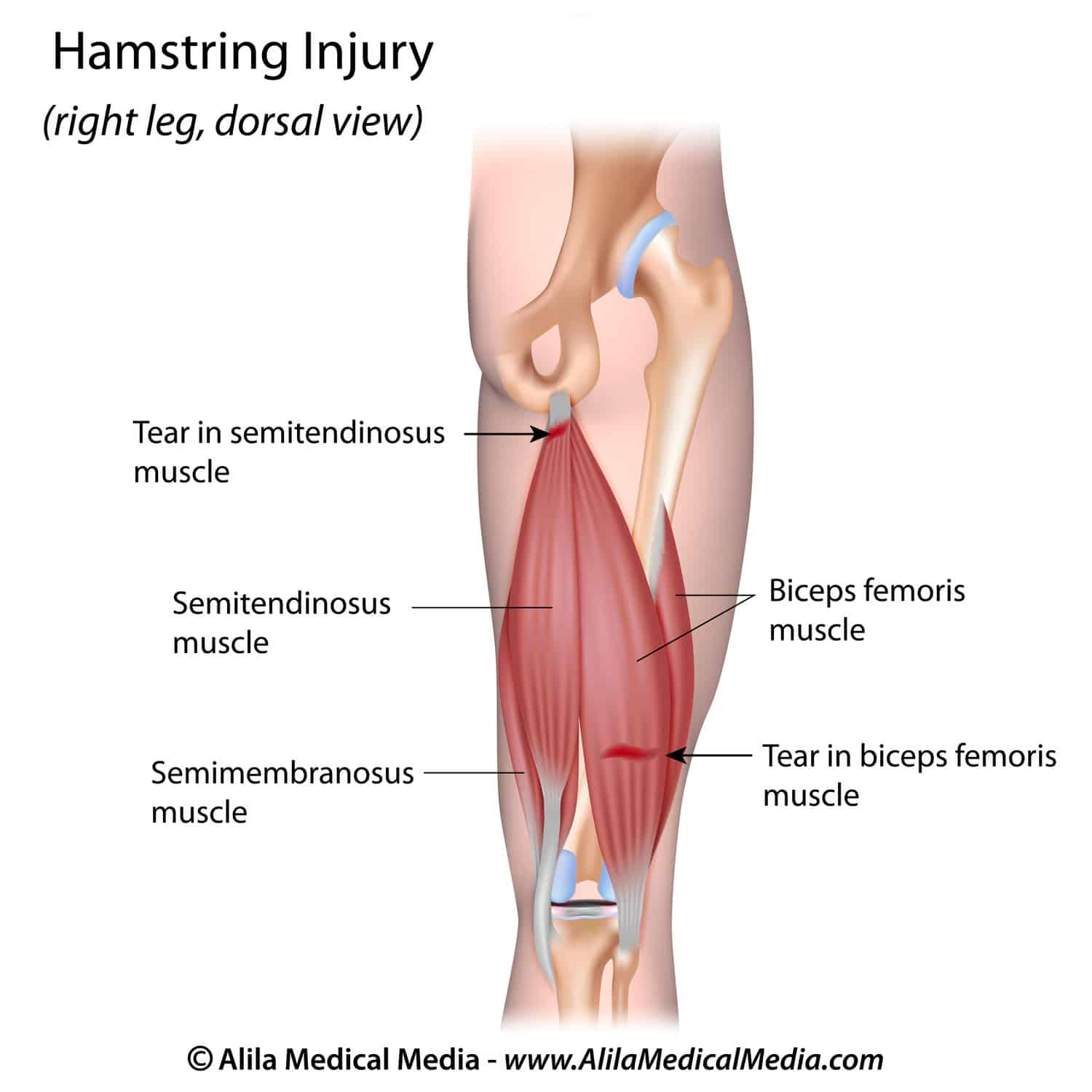 Hamstring Injury
