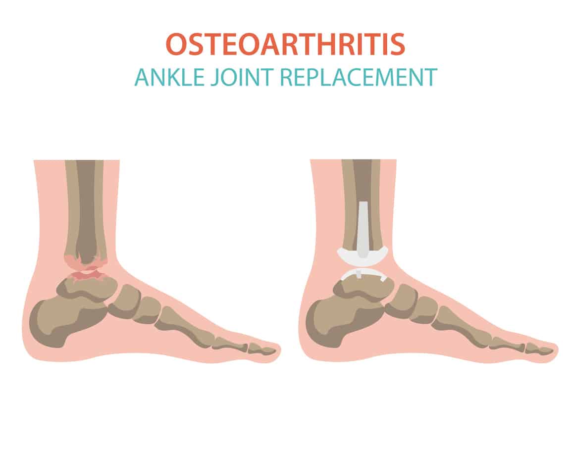 Arthritis, osteoarthritis medical infographic design. Joint replacement, implantant
