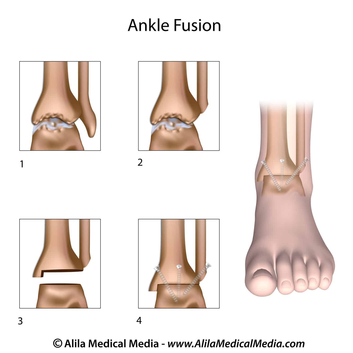Ankle fusion surgery