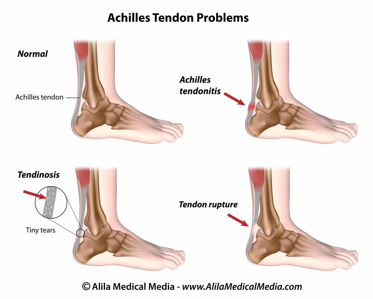 Achilles tendon problems