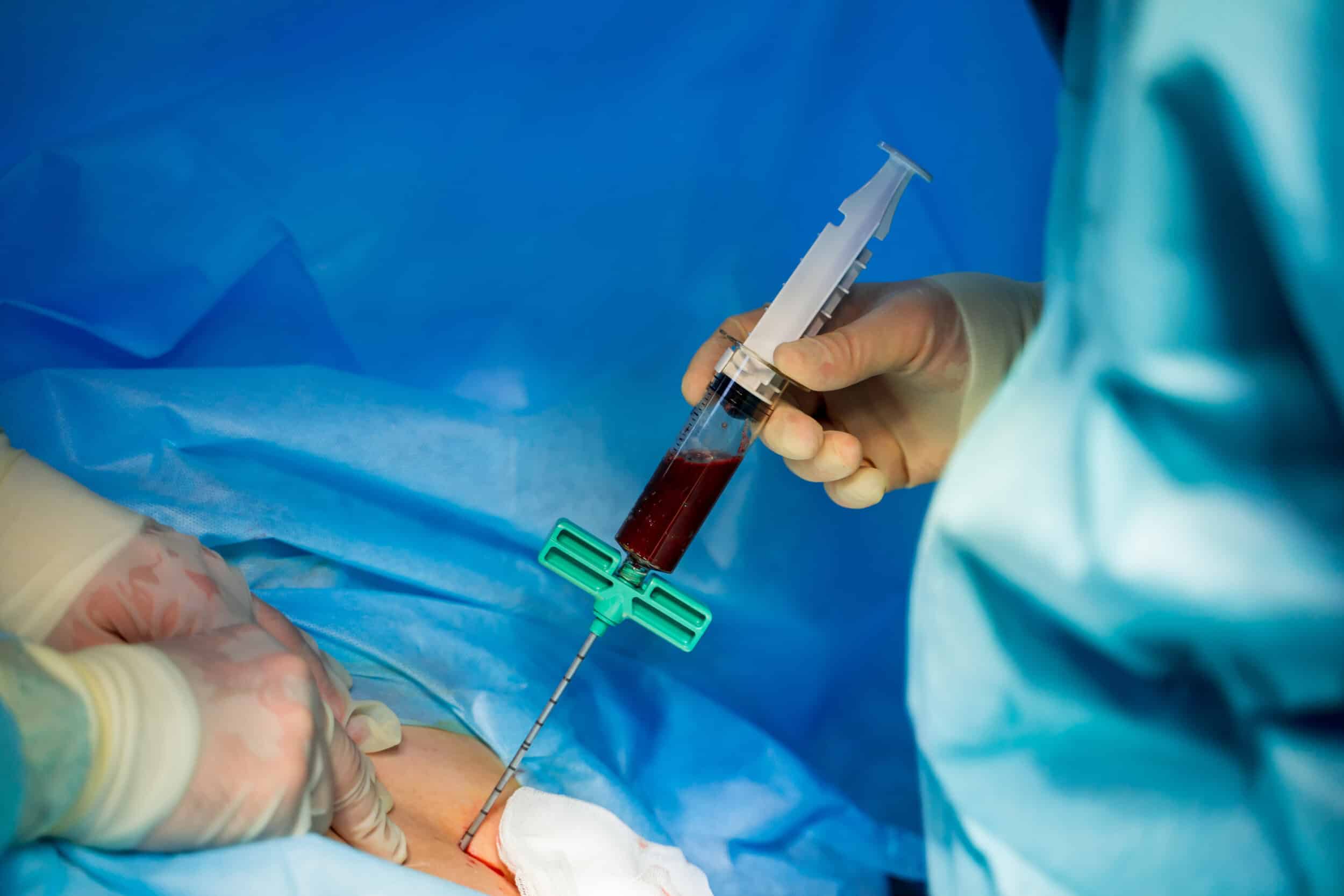 Plasma,In,Syringe.,Specialist,Makes,Injection,With,Syringe.,Profeccional,Treatment.