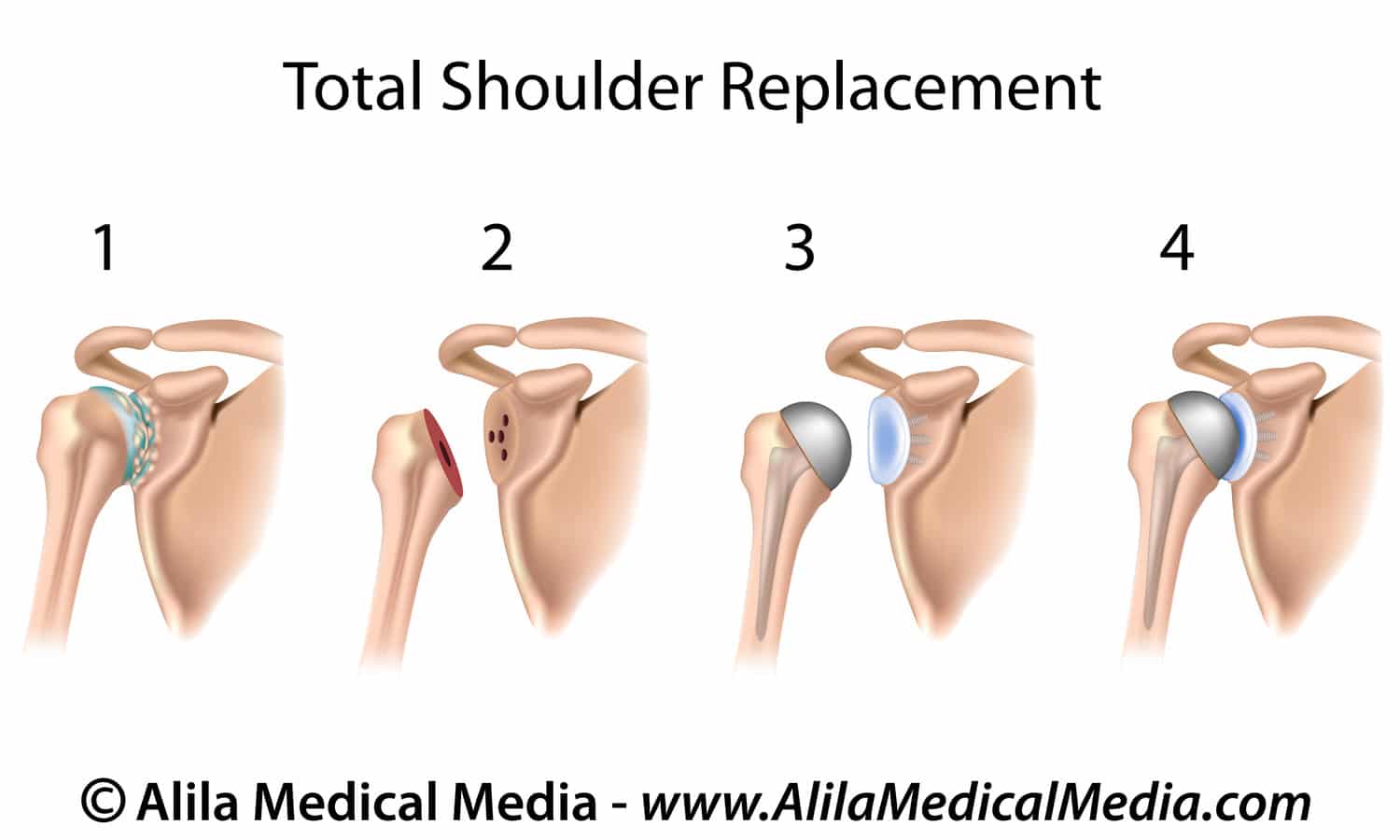 A.B. shoulder replacement