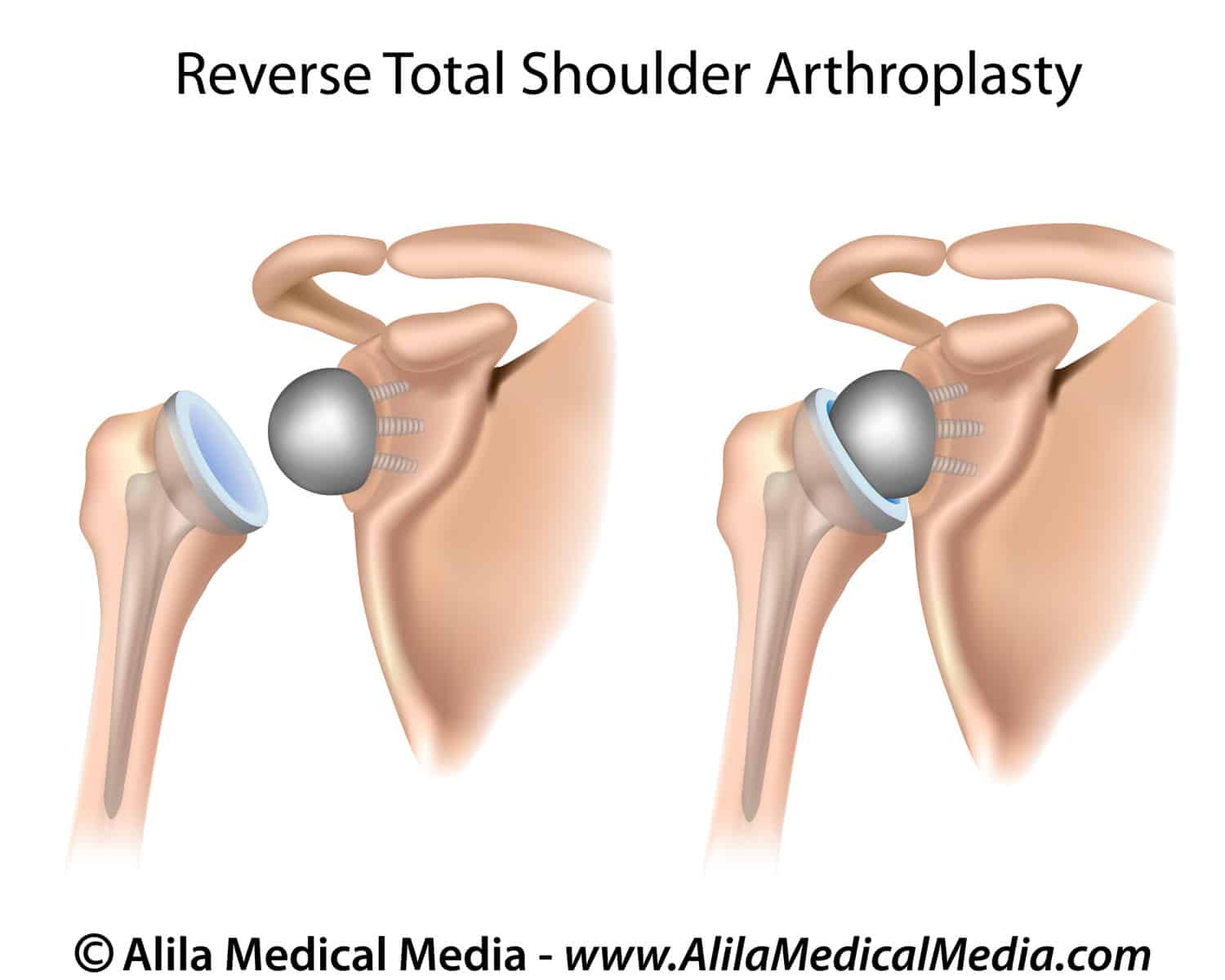 reverse total shoulder replacement